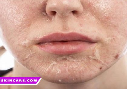 درمان خشکی پوست صورت و پوسته پوسته شدن در تبریز